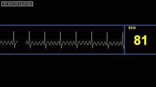 Aflutter Waveform  Simulated Patient Waveform [upl. by Aihk]