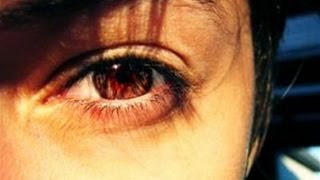 How To Understand The Symptoms Of Optic Neuritis [upl. by Annahoj18]