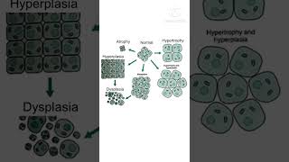 nursingmcq nursingcompetitiveexam nursingofficermcq cellular adaptation MetaplasiaDysplasia [upl. by Imas]