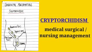 cryptorchidismmedical surgical topic nursing course [upl. by Ahsikad]