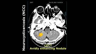 Neuro cysticercosis NCC [upl. by Lemmor377]