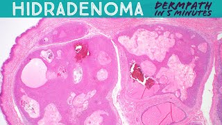 Hidradenoma Acrospiroma Dermpath in 5 Minutes Pathology Dermatology Dermatopathology [upl. by Anrak]