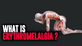 What is Erythromelalgia [upl. by Reh]