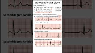 Atrioventricular block [upl. by Thurmond]