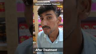 Hyperpigmentation Treatment skincare Hyperpigmentation pigmentation skinwhitening [upl. by Stralka]