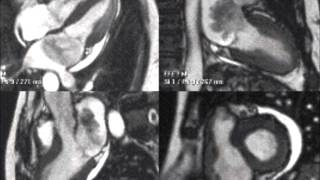 Cardiac MRI Myxoma [upl. by Boynton]