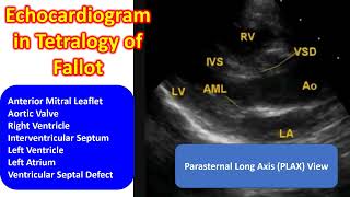 Echocardiogram in Tetralogy of Fallot [upl. by Kerby]