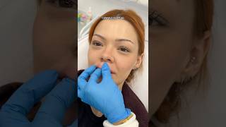 getting my fillers dissolved😳 [upl. by Arreis]