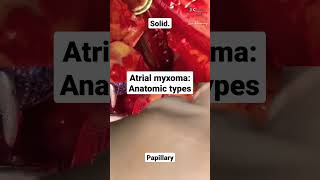 Atrial myxoma anatomic types [upl. by Gavette]