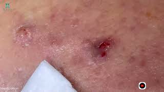 Big Cystic Acne Blackheads Extraction Blackheads amp Milia Whiteheads Removal Pimple Popping [upl. by Adran]