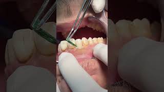 Anterior teeth composite restoration dentist [upl. by Arayt543]