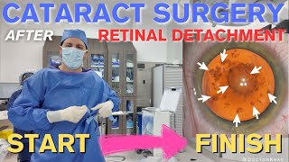 Cataract Surgery after Retinal Detachment  3 Min Polishing  Full Video from Start to Finish [upl. by Etan]