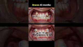 42 months for this braces casr braces orthodontist bracesoff bracesbeforeandafter [upl. by Vasti]