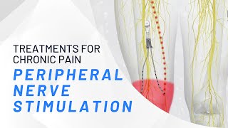 Peripheral Nerve Stimulation  What You Need To Know [upl. by Zetroc681]