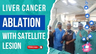 Liver Cancer Ablation with Satellite Lesion  IRFACILITIES LiverCancer Cancer doctor [upl. by Mchale933]