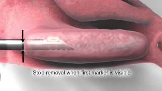 Turbinoplasty  Downtown Los Angeles  LA Sinus amp Allergy Specialists [upl. by Nattie]