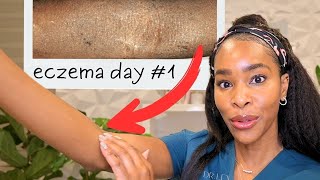 12 Life Changing Tips For Eczema From a Derm with Eczema [upl. by Erlewine374]