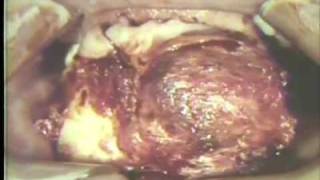 Removal of Large Ameloblastoma of Mandible [upl. by Flower]