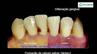 1 Doença periodontal avançada [upl. by Kilmarx]