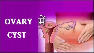 Ovary में Cyst या बच्चे न होना तो करे यह रामबांड उपाय  Ovary Cyst Treatment [upl. by Ellehsram]