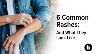 6 Common Rashes And What They Look Like  Healthline [upl. by Kral]