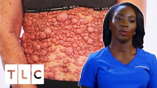 Doctor Treats One Of The Most Extensive Cases Of Neurofibromatosis She’s Ever Seen  Dr Mercy [upl. by Joellen]