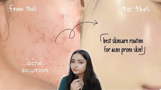 Best skin care routine for acne prone skin Acne pimples treatment  dark spots and scars [upl. by Gebelein]