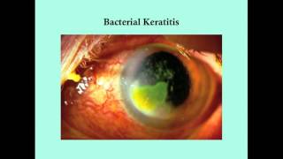 Keratitis  CRASH Medical Review Series [upl. by Waylon]