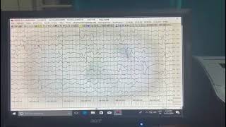 Coma clinical electrophysiology 75F with coma diagnostic uncertainty [upl. by Careaga]