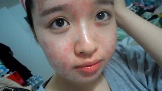 My Acne Story 10th week of Accutane [upl. by Eenaej]