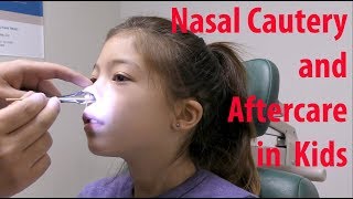 Pediatric Nosebleed Cauterization and Aftercare [upl. by Meadows675]