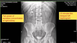 CASE 58 IVP Delayed faint persistent left nephrogram Dr AHMED ESAWY [upl. by Acima]