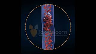 Inferior Vena Cava Filter [upl. by Maclean]