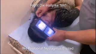 Augmented Right Half Hallpike Test [upl. by Devol]