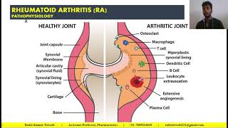 Rheumatoid Arthritis Pathophysiology in HINDI by Rohit Kumar Trivedi [upl. by Llerrud]