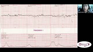 CARDIOTOCOGRAFÍA FETAL DE PATRÓN NORMAL Y PATOLÓGICO CLASE V [upl. by Okihcim]