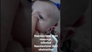 Nasolacrimal duct massageinfected Nasolacrimal duct obstruction Dr Hunar Jamal [upl. by Turino]