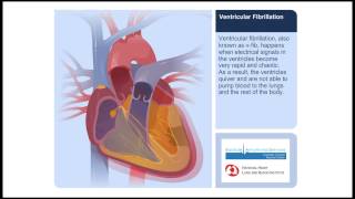 Supraventricular tachycardia SVT  An Abnormal rhythm [upl. by Tomasine]