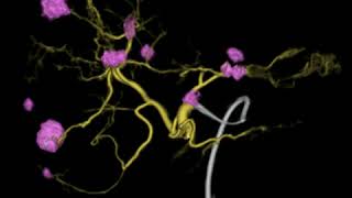 transcatheter arterial chemoembolization [upl. by Buddie]