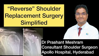 Reverse Shoulder Joint Replacement A Complete Overview by Shoulder Surgeon Dr Prashant Meshram [upl. by Malamut]