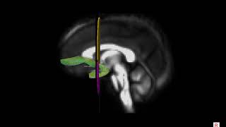 DTI of the human uncinate fasciculus UNC [upl. by Portingale]