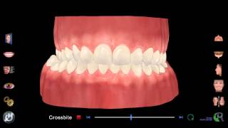 Crossbite [upl. by Esmerelda]