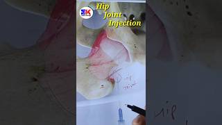 Hip Joint Injection medicineknowledgehindi shorts [upl. by Lenor]