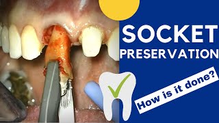 Tooth extraction and SOCKET PRESERVATION  How is it done [upl. by Ivad]