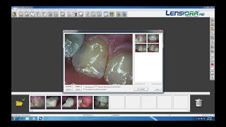 Lensiora HD Intraoral Camera Examination with VixWin Gendex [upl. by Barnaby]