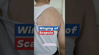 Winging of scapula viral education physiotherapy [upl. by Neeka]