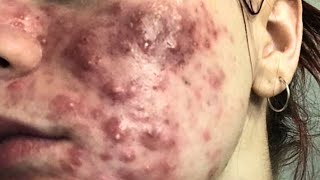 cystic acne blackhead whitehead removal  Relaxing Spa Acne Treatment [upl. by Maitland]