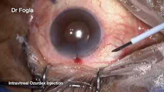 Intravitreal Ozurdex Injection [upl. by Leile106]