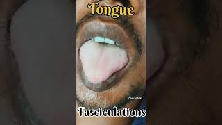 Tongue Fasciculations fasciculation snakebite neurotoxin clinicaltalks [upl. by Neral148]