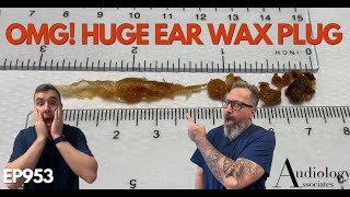 OMG HUGE EAR WAX PLUG REMOVED  EP953 [upl. by Mayworm]